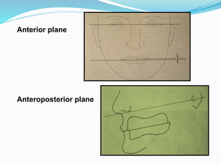 Anterior plane
Anteroposterior plane
 