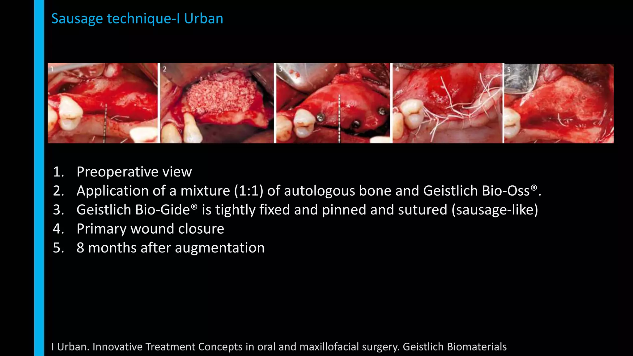 Vertical ridge augmentation | PPTX