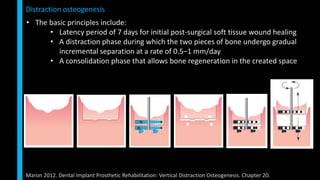 Vertical ridge augmentation | PPTX