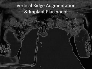 Vertical Ridge Augmentation
& Implant Placement
 