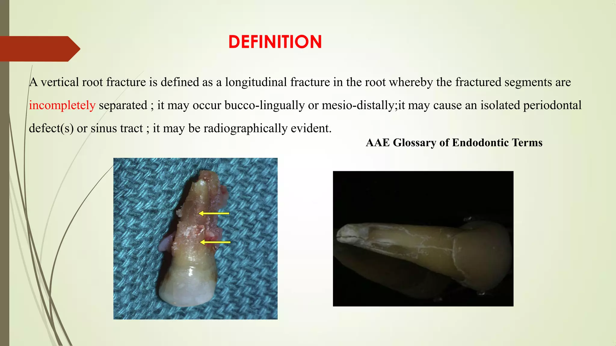 VERTICAL ROOT FRACTURE !.pdf