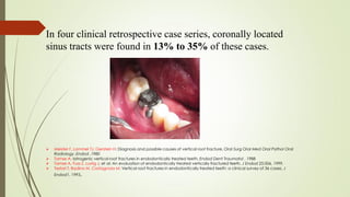 In four clinical retrospective case series, coronally located
sinus tracts were found in 13% to 35% of these cases.
 Meister F, Lommel TJ, Gerstein H: Diagnosis and possible causes of vertical root fracture, Oral Surg Oral Med Oral Pathol Oral
Radiology ,Endod ,1980
 Tamse A: Iatrogenic vertical root fractures in endodontically treated teeth, Endod Dent Traumatol , 1988
 Tamse A, Fuss Z, Lustig J, et al: An evaluation of endodontically treated vertically fractured teeth, J Endod 25:506, 1999.
 Testori T, Badino M, Castagnola M: Vertical root fractures in endodontically treated teeth: a clinical survey of 36 cases, J
Endod1, 1993.
 