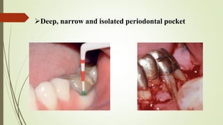 Deep, narrow and isolated periodontal pocket
 