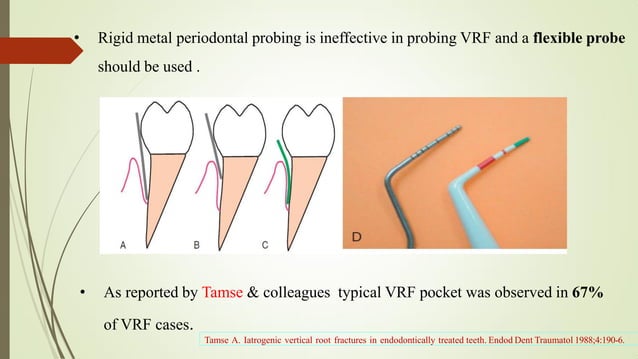 VERTICAL ROOT FRACTURE !.pdf