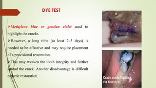Methylene blue or gentian violet used to
highlight the cracks.
However, a long time (at least 2–5 days) is
needed to be effective and may require placement
of a provisional restoration.
This may weaken the tooth integrity and further
spread the crack. Another disadvantage is difficult
esthetic restoration.
DYE TEST
 