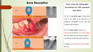 Early versus late radiographic
presentation of a VRF-associated
bone defect.
(A, B).- At an early stage, a bone defect
(red) is not likely to be detected in a
periapical radiograph, as the root will
overlap with the defect.
(C, D) At later stages, when major
damage has occurred to the cortical plate,
the bone defect may be large enough to
extend beyond the silhouette of the root.
( E)appear as a radiolucent defect along
the root.
Bone Resorption
 