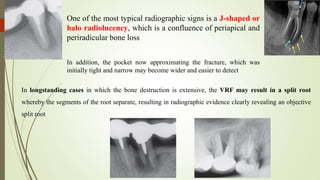 One of the most typical radiographic signs is a J-shaped or
halo radiolucency, which is a confluence of periapical and
periradicular bone loss
In addition, the pocket now approximating the fracture, which was
initially tight and narrow may become wider and easier to detect
In longstanding cases in which the bone destruction is extensive, the VRF may result in a split root
whereby the segments of the root separate, resulting in radiographic evidence clearly revealing an objective
split root
 