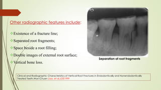 Other radiographic features include:
Existence of a fracture line;
Separated root fragments;
Space beside a root filling;
Double images of external root surface;
Vertical bone loss.
Separation of root fragments
Clinical and Radiographic Characteristics of Vertical Root Fractures in Endodontically and Nonendodontically
Treated Teeth,Wan-Chuen Liao, et al,JOE1999
 