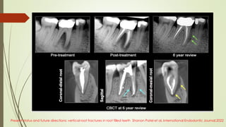 Present status and future directions: vertical root fractures in root filled teeth Shanon Patel et al, International Endodontic Journal,2022
 