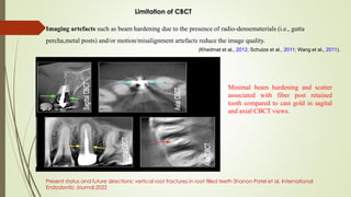 Imaging artefacts such as beam hardening due to the presence of radio-densematerials (i.e., gutta
percha,metal posts) and/or motion/misalignment artefacts reduce the image quality.
Limitation of CBCT
(Khedmat et al., 2012; Schulze et al., 2011; Wang et al., 2011).
Present status and future directions: vertical root fractures in root filled teeth Shanon Patel et al, International
Endodontic Journal,2022
Minimal beam hardening and scatter
associated with fiber post retained
tooth compared to cast gold in sagital
and axial CBCT views.
 
