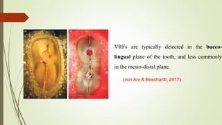 VRFs are typically detected in the bucco-
lingual plane of the tooth, and less commonly
in the mesio-distal plane.
(von Arx & Bosshardt, 2017)
 