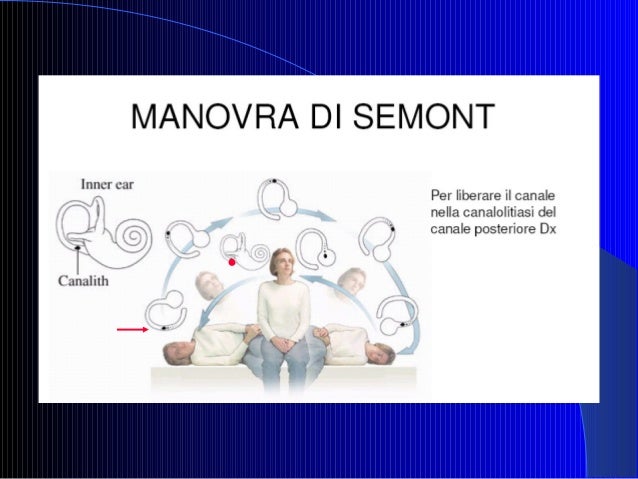 Insufficienza Vertebro Basilare Si Guarisce