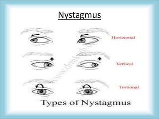 Nystagmus
 