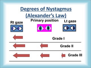 Rt gaze Lt gaze
Degrees of Nystagmus
(Alexander’s Law)
Grade I
Grade III
Grade II
Primary position
 