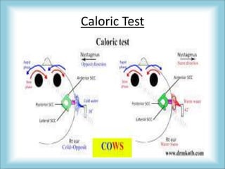 Caloric Test
 
