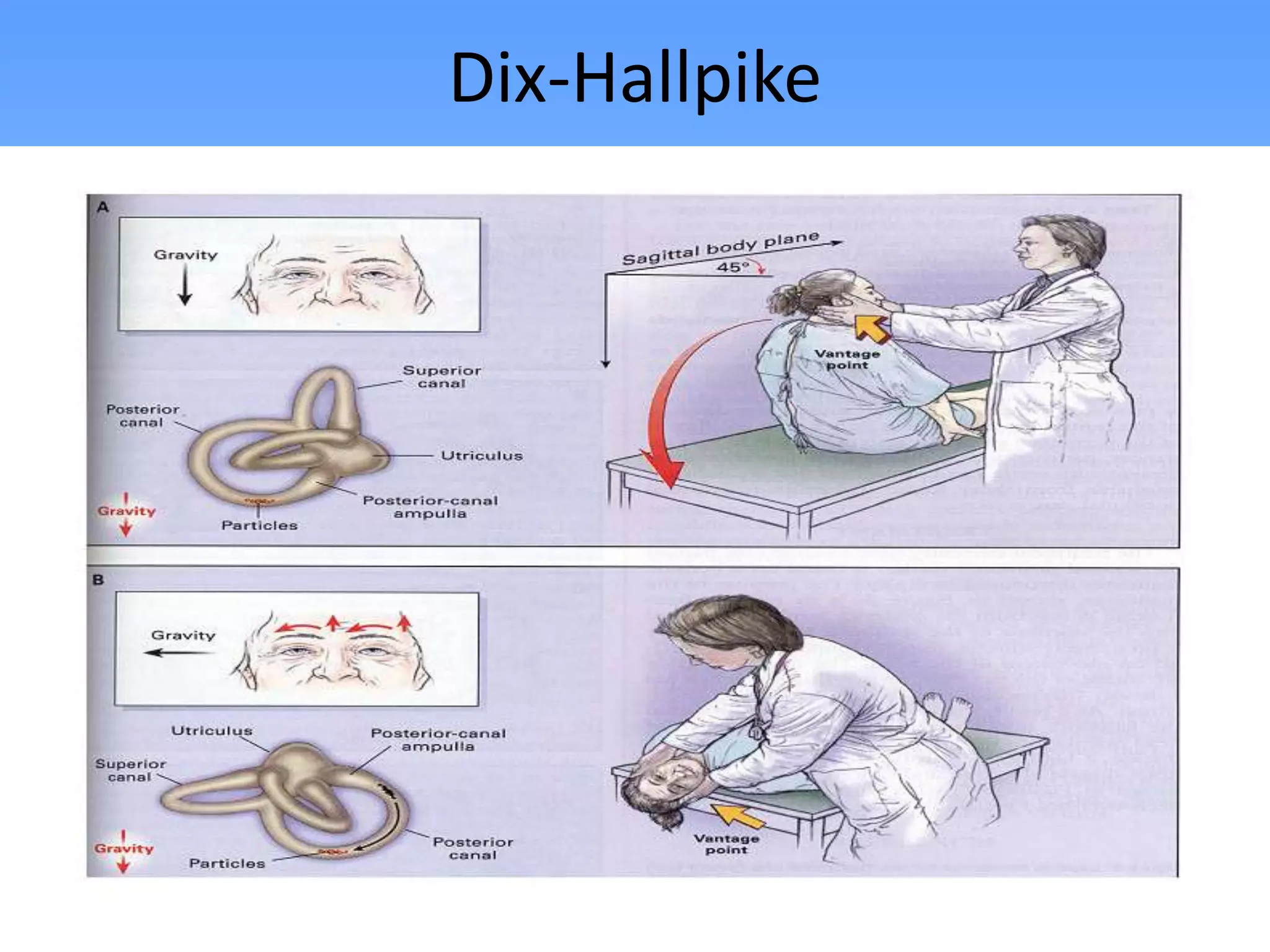 Dix-Hallpike