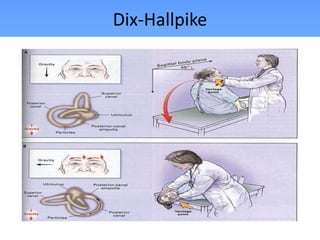 Dix-Hallpike
 