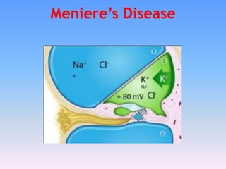 Meniere’s Disease
 