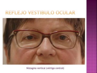Nistagmo vertical (vértigo central)
 