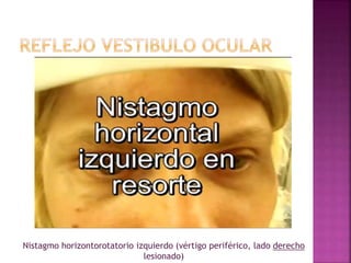 Nistagmo horizontorotatorio izquierdo (vértigo periférico, lado derecho
lesionado)
 