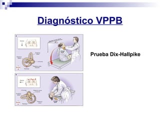 Diagnóstico VPPB
Prueba Dix-Hallpike
 