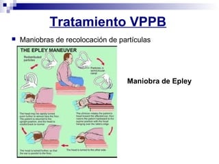 Tratamiento VPPB
 Maniobras de recolocación de partículas
Maniobra de Epley
 