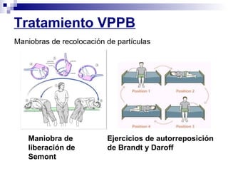 Tratamiento VPPB
Maniobras de recolocación de partículas
Maniobra de
liberación de
Semont
Ejercicios de autorreposición
de Brandt y Daroff
 