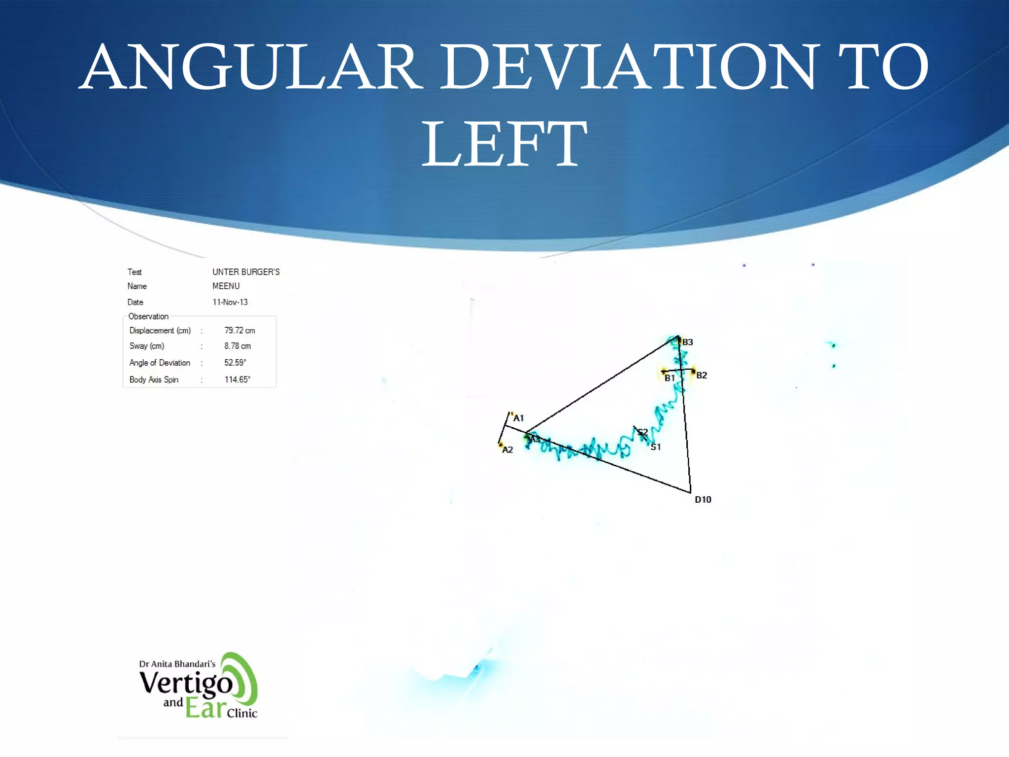 ANGULAR DEVIATION TO
LEFT
 