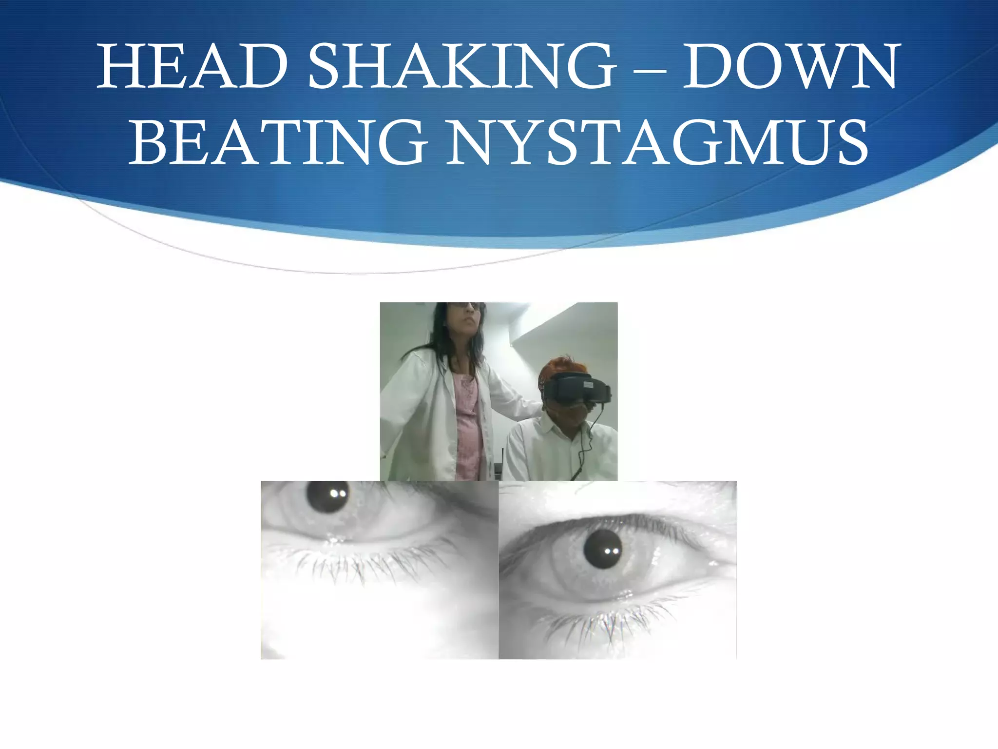 HEAD SHAKING – DOWN
BEATING NYSTAGMUS
 