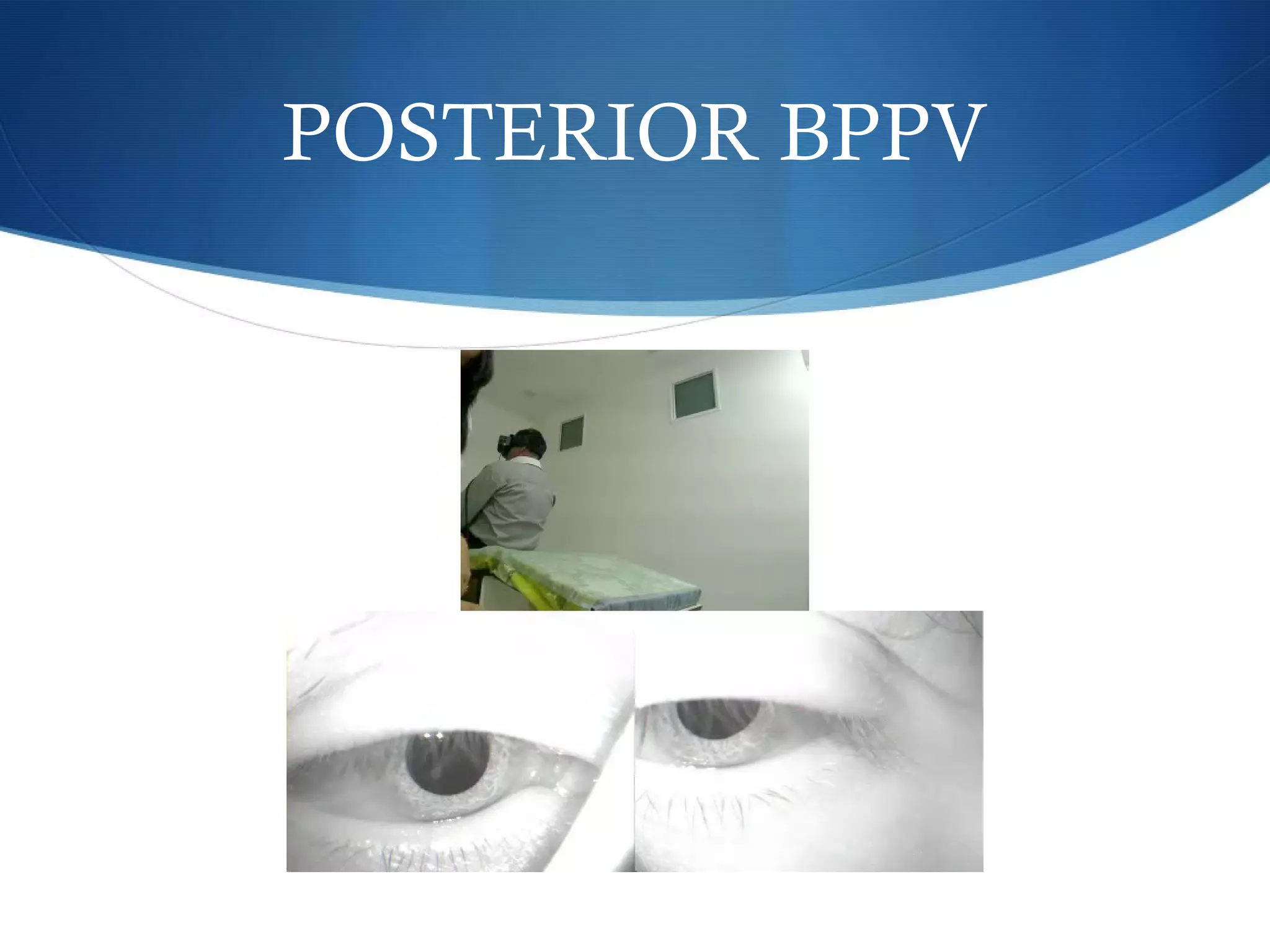 POSTERIOR BPPV
 