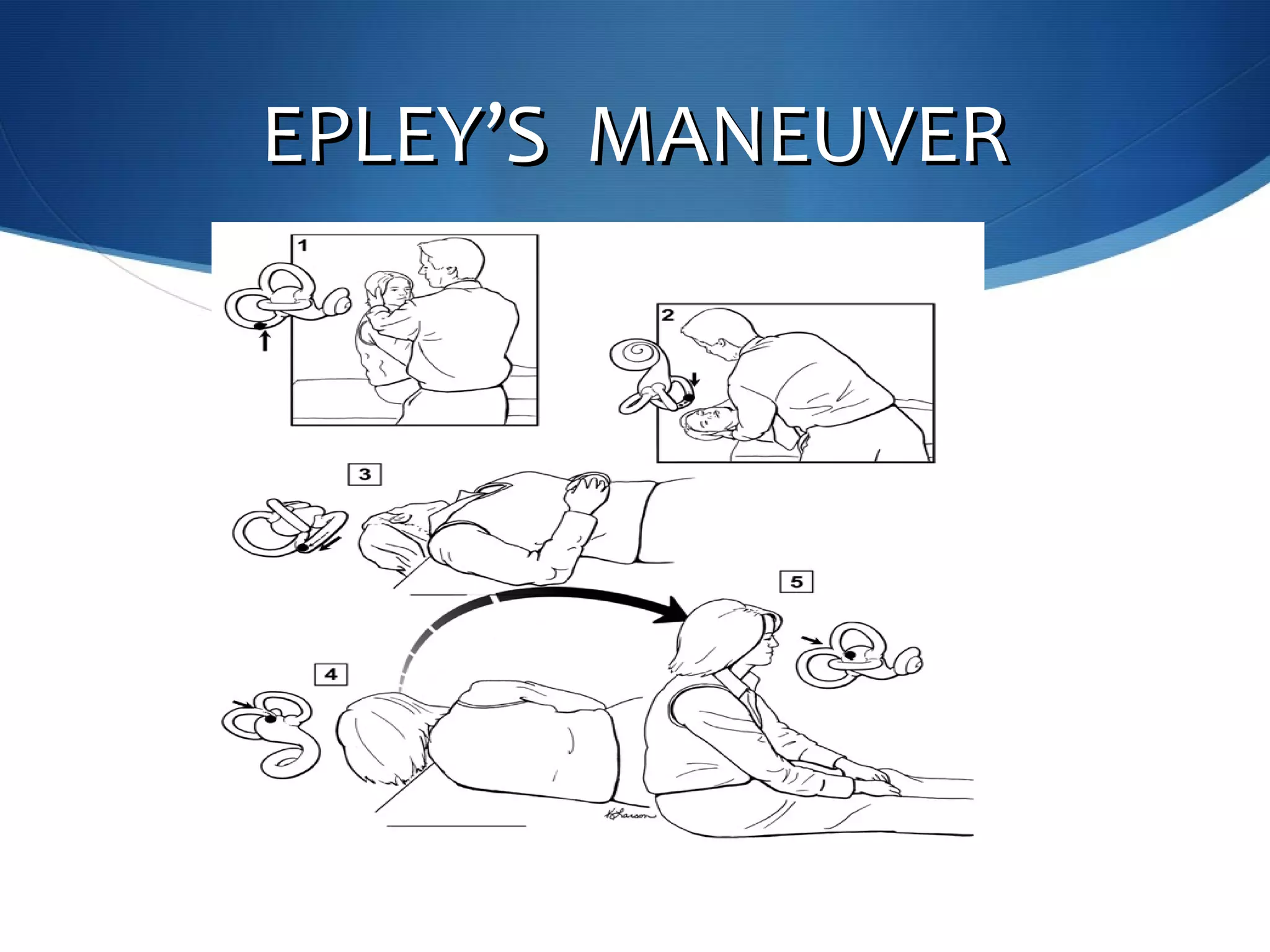 EPLEYEPLEY’’S MANEUVERS MANEUVER
 