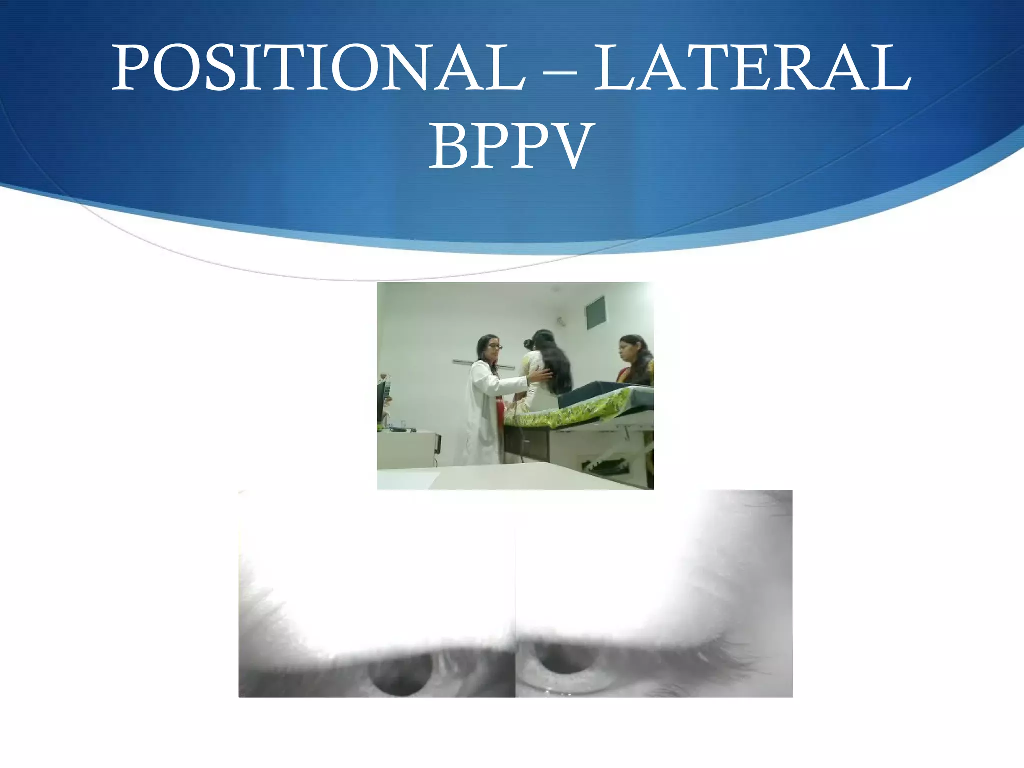 POSITIONAL – LATERAL
BPPV
 