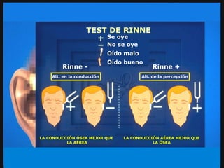 TEST DE RINNE Se oye No se oye Oído malo Oído bueno Alt. en la conducción Alt. de la percepción LA CONDUCCIÓN ÓSEA MEJOR QUE  LA AÉREA LA CONDUCCIÓN AÉREA MEJOR QUE LA ÓSEA Rinne - Rinne + betahistina 