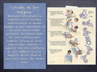 - Prueba de Dix-
Hallpike:
Mediante esta prueba se
exploran varios canales
semicirculares al mismo
tiempo, el más importante es
el canal semicircular
posterior del mismo lado
del giro cefálico, pero
también incluye el canal
semicircular anterior o
superior del oído contrario
al giro cefálico y en la
mayoría de los casos el
canal horizontal del mismo
lado.
 