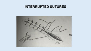 INTERRUPTED SUTURES
 