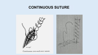 CONTINUOUS SUTURE
 