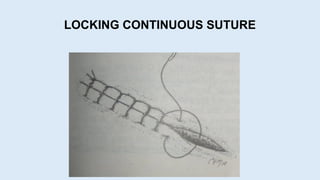 LOCKING CONTINUOUS SUTURE
 