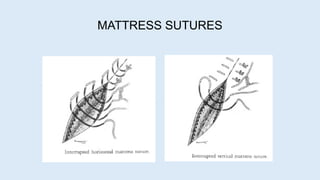 MATTRESS SUTURES
 
