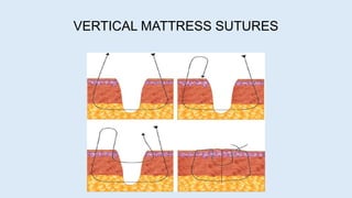 VERTICAL MATTRESS SUTURES
 