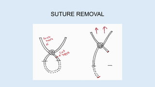 SUTURE REMOVAL
 