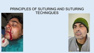 PRINCIPLES OF SUTURING AND SUTURING
TECHNIQUES
 