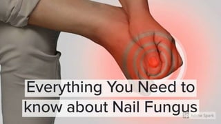 Everything you need to know about nail fungus - RingOut