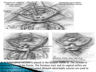 A: A longitudinal incision is placed in the bladder dome. B: The incision is
extended around the fistula. The fistulous tract and its vaginal orifice are
completely excised. C: Interrupted delayed-absorbable sutures are used to
close the vagina in one or two layers.
 