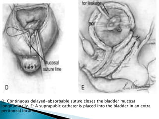 D: Continuous delayed-absorbable suture closes the bladder mucosa
longitudinally. E: A suprapubic catheter is placed into the bladder in an extra
peritoneal location.
 