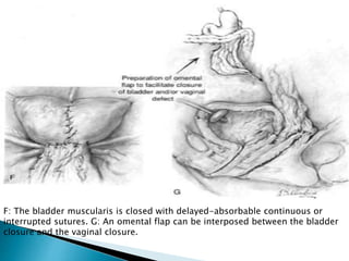 F: The bladder muscularis is closed with delayed-absorbable continuous or
interrupted sutures. G: An omental flap can be interposed between the bladder
closure and the vaginal closure.
 