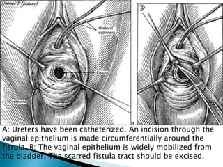 A: Ureters have been catheterized. An incision through the
vaginal epithelium is made circumferentially around the
fistula. B: The vaginal epithelium is widely mobilized from
the bladder. The scarred fistula tract should be excised.
 