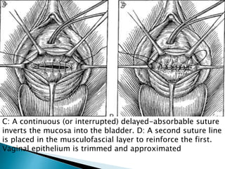 C: A continuous (or interrupted) delayed-absorbable suture
inverts the mucosa into the bladder. D: A second suture line
is placed in the musculofascial layer to reinforce the first.
Vaginal epithelium is trimmed and approximated
 