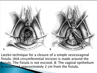 Latzko technique for a closure of a simple vesicovaginal
fistula. (A)A circumferential incision is made around the
fistula. The fistula is not excised. B: The vaginal epithelium
is mobilized approximately 2 cm from the fistula.
 