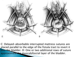 C: Delayed-absorbable interrupted mattress sutures are
placed parallel to the edge of the fistula tract to invert it
into the bladder. D: One or two additional rows of suture
approximate the musculofascial layer of the bladder.
 