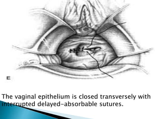 The vaginal epithelium is closed transversely with
interrupted delayed-absorbable sutures.
 